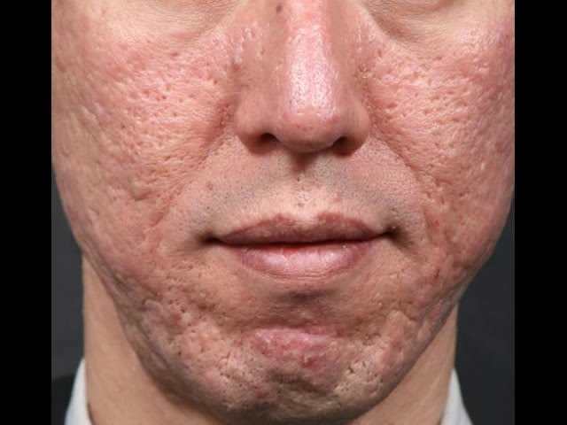 Treatment for Severe Nodular or Cystic Acne